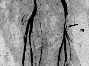Магнитно-резонансная ангиография сосудов ног липосаркома