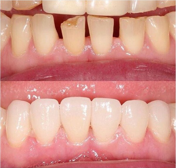 сколько болят зубы после установки виниров